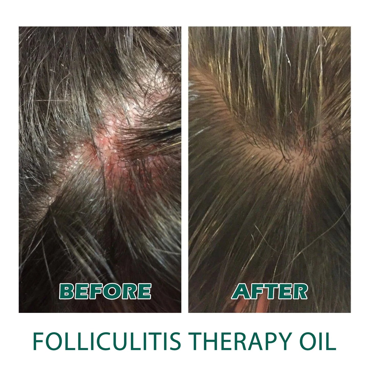 Scalp Treatment Serum – Hair Growth & Anti-Dandruff