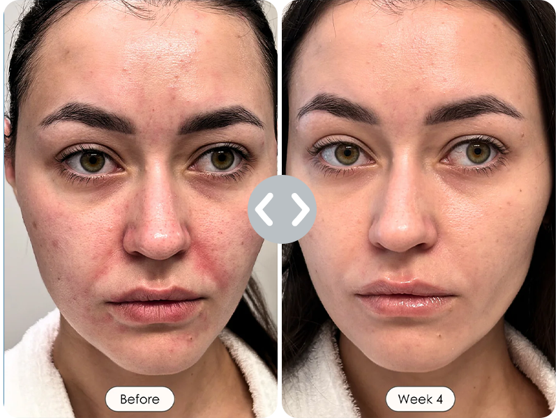 Redness & Inflammation
