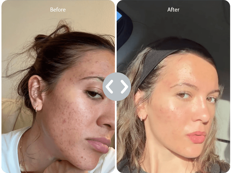 Acne & Blemishes